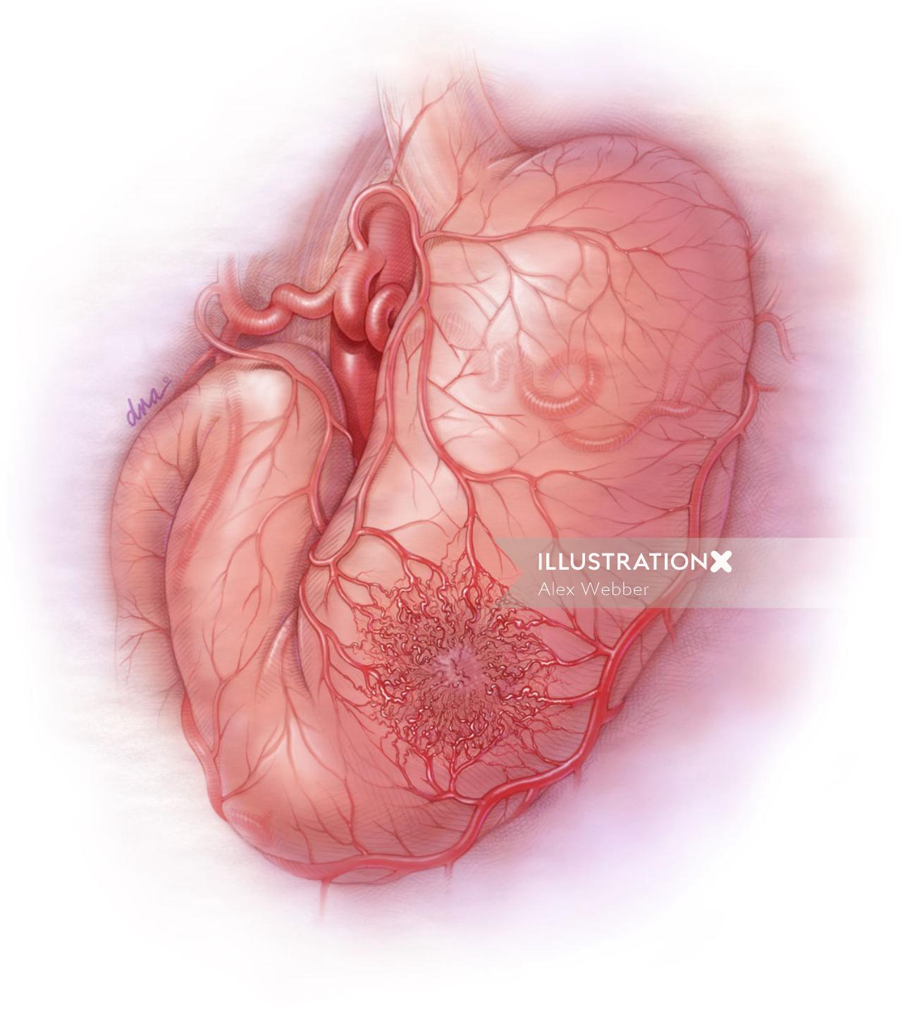 Uma ilustração do tumor em stomuch