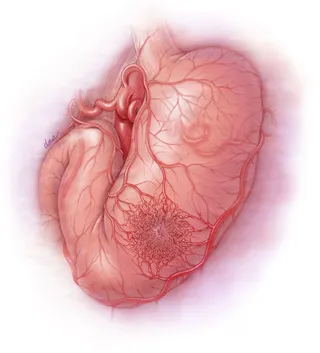 Illustration for an article on drug interruption of angiogenesis