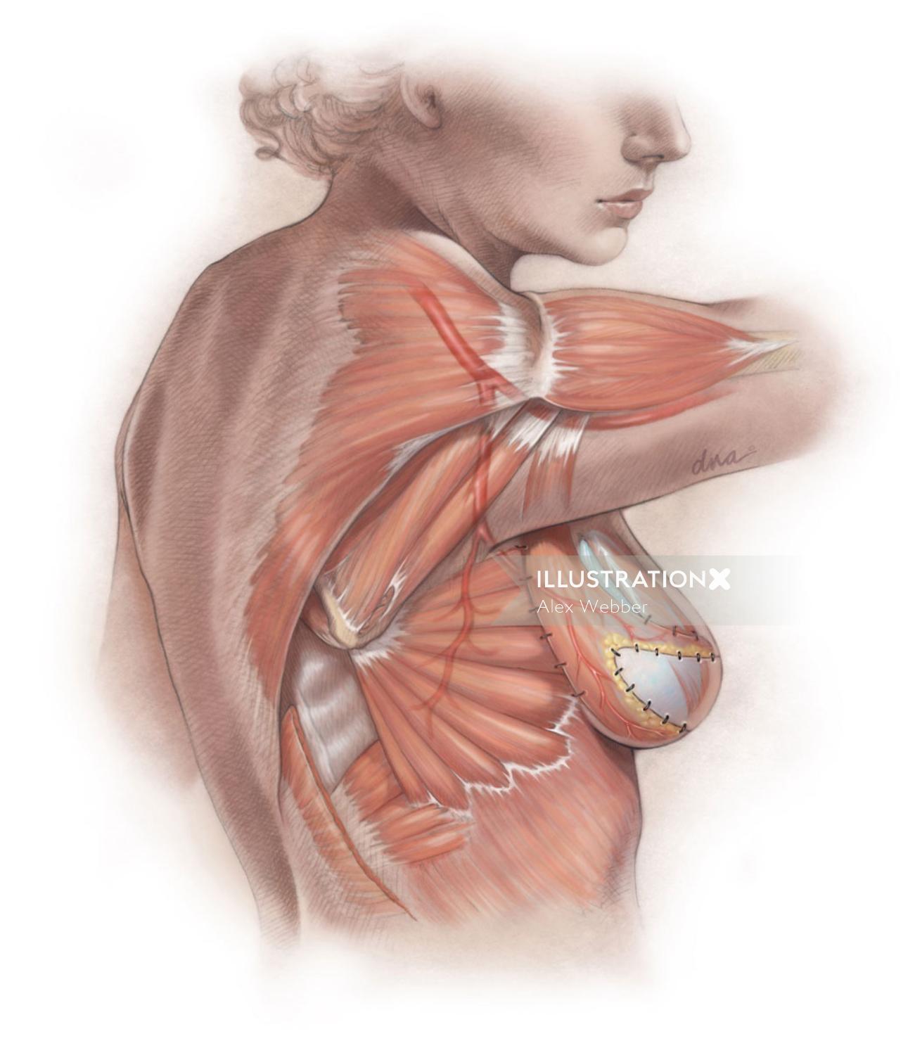 Reconstrução mamária com cirurgia de retalho por Alex Webber