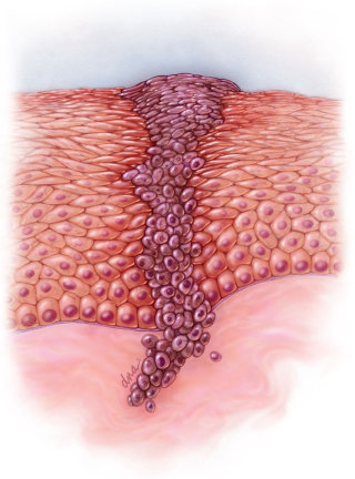 Ilustración digital de melanoma maligno