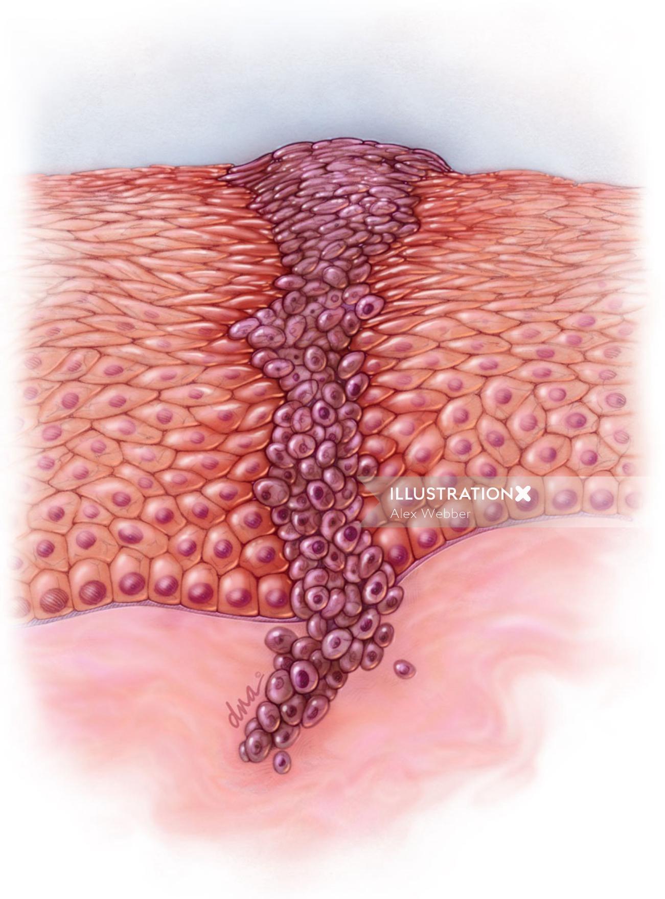 Uma ilustração do melanoma