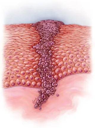 Malignant melanoma digital illustration