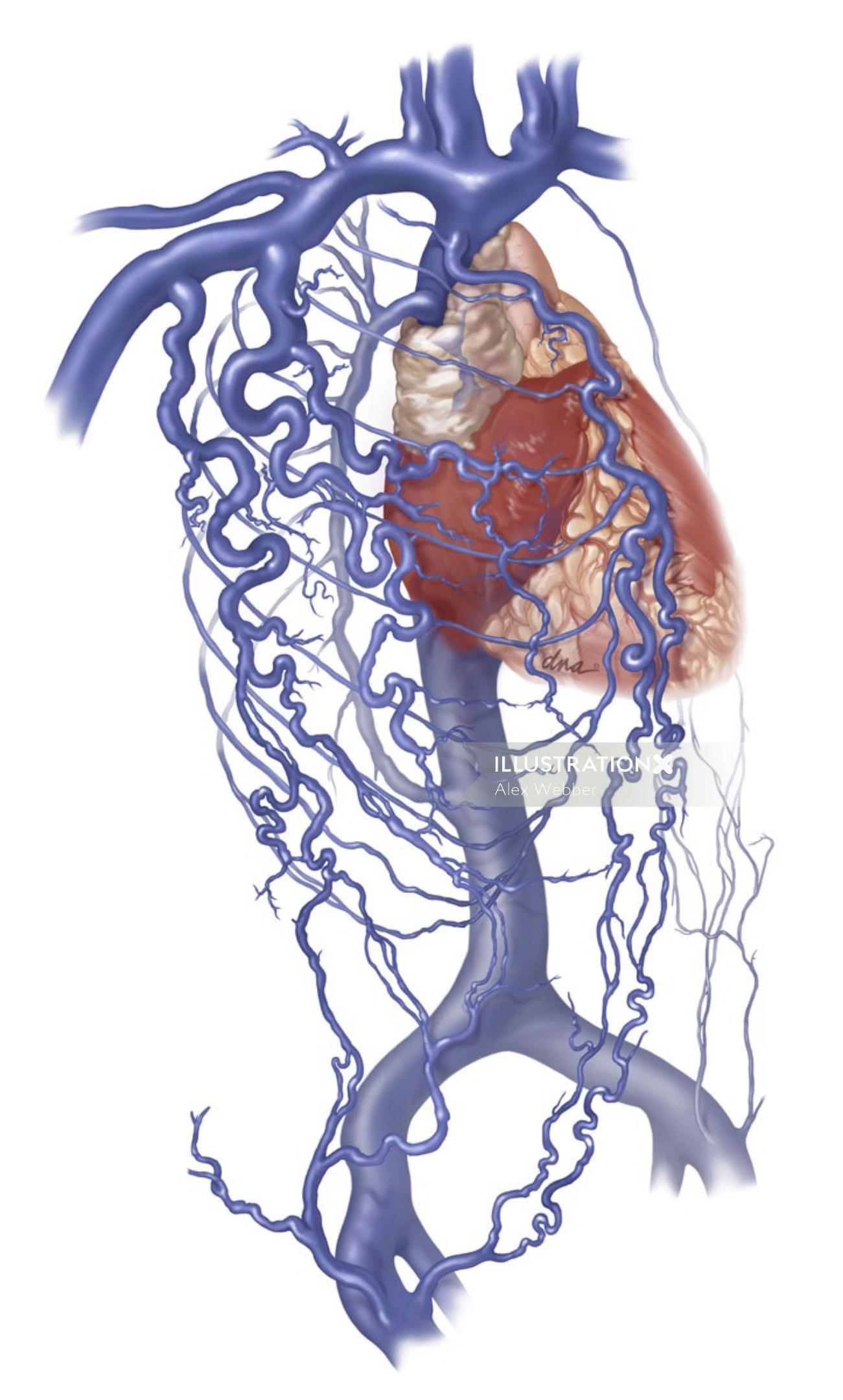 Ilustrações médicas da Síndrome da Veia Cava Superior