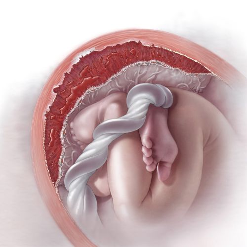 Illustration about the diagnosis of abnormal placentation for Medical Magazine