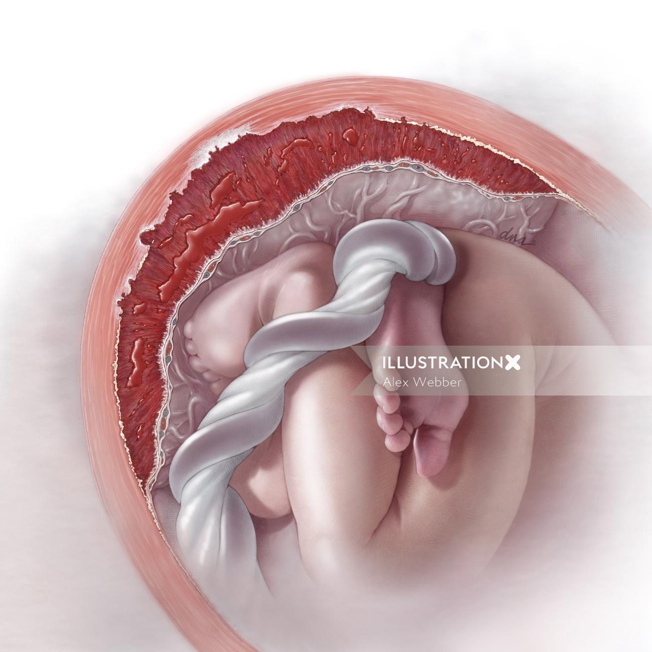 Ilustração sobre o diagnóstico de placentação anormal para Revista Médica