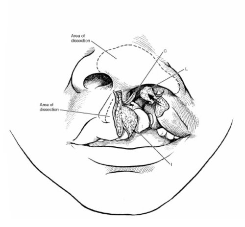 Medical illustration of area of dissection 
