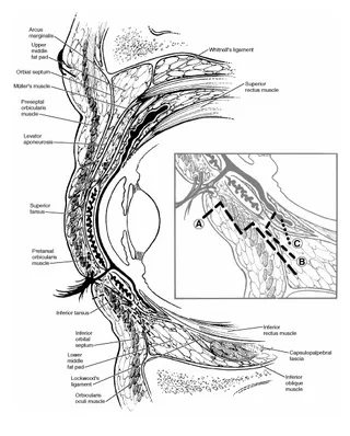 Anatomy drawing of eyelid surgery