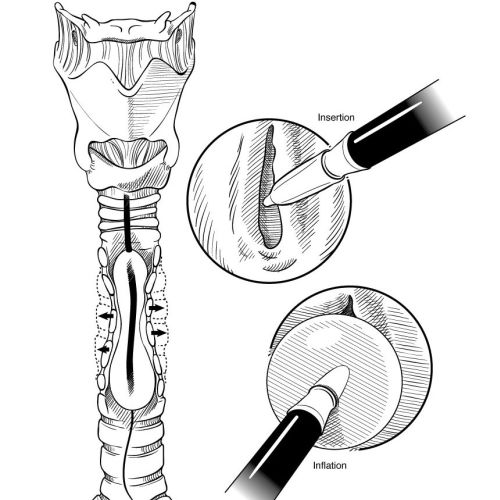 Medical illustration of operation
