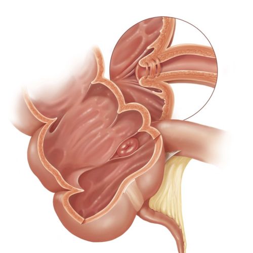 Basic medical illustration showing Ileocecal valve