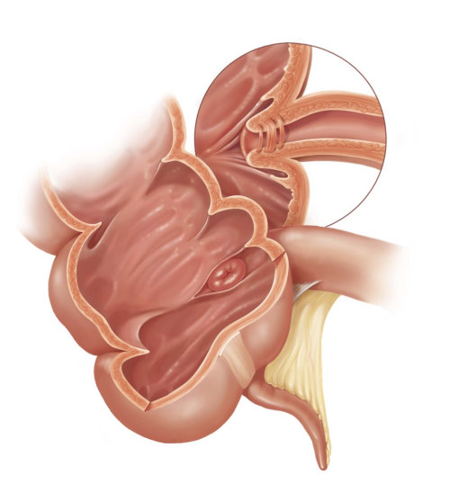 Basic medical illustration showing Ileocecal valve