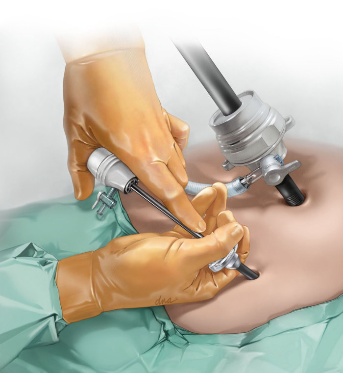 腹腔鏡手術の写実的なイラスト