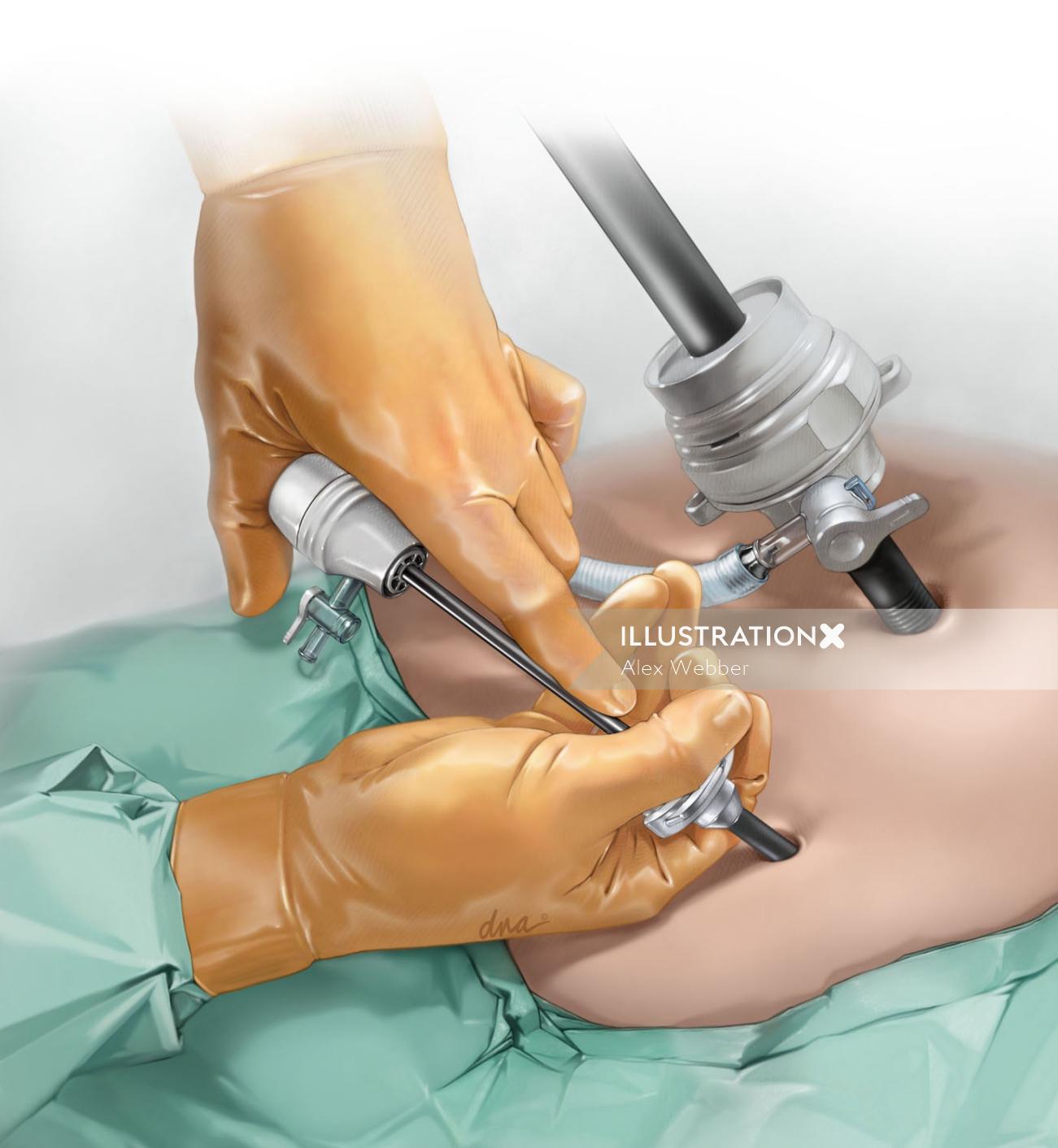Ilustração fotorrealista de cirurgia laparoscópica