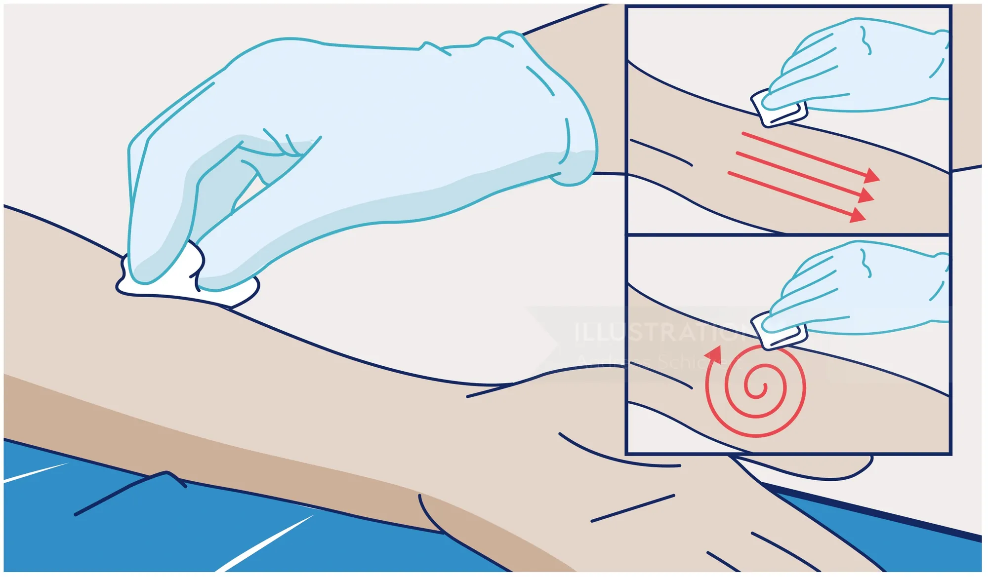 Hand cleaning an arm wound with cotton and antiseptic