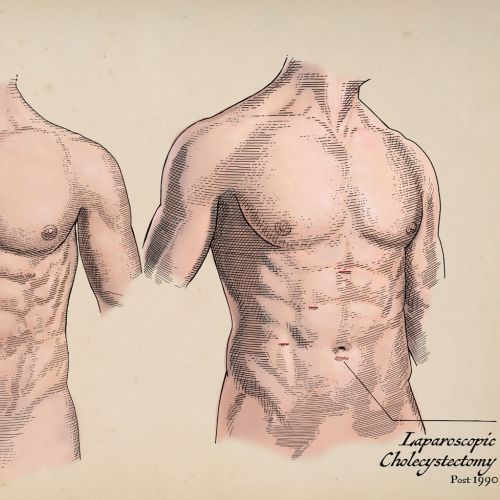 Medical illustration of Traditional Cholecystectomy