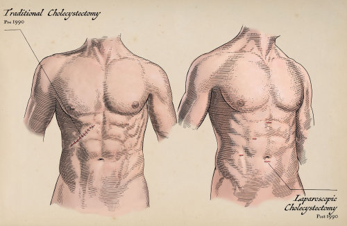 Ilustración médica de colecistectomía tradicional