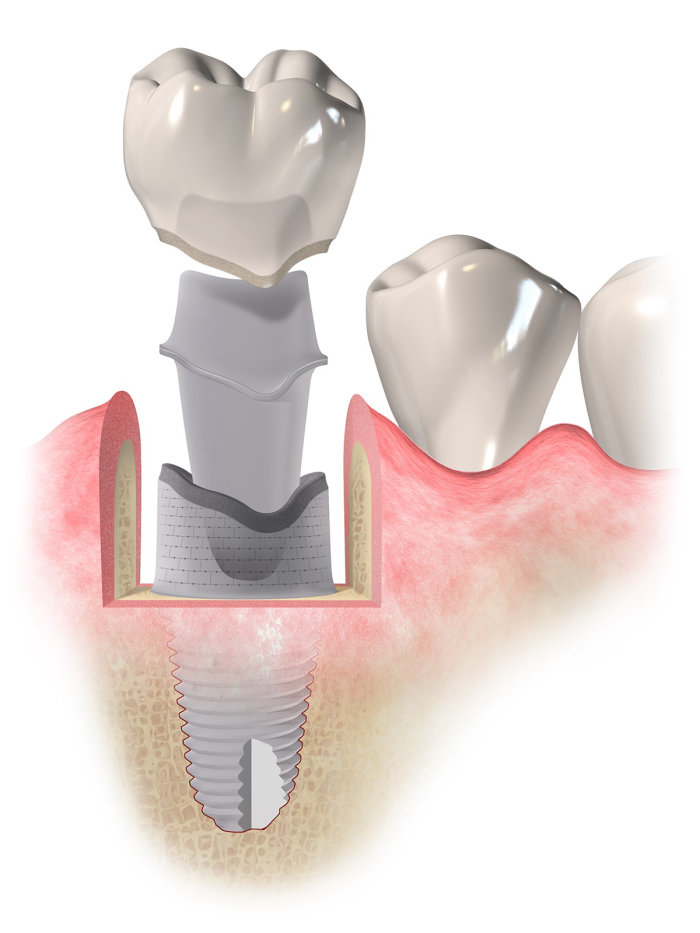 Medical illustration dental implant
