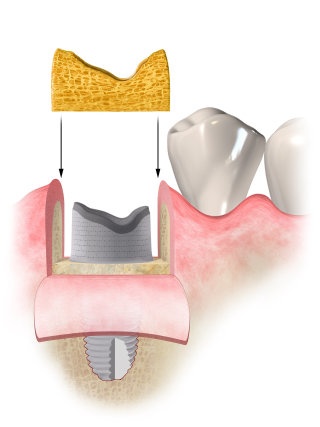 Ilustración médica del procedimiento dental.

