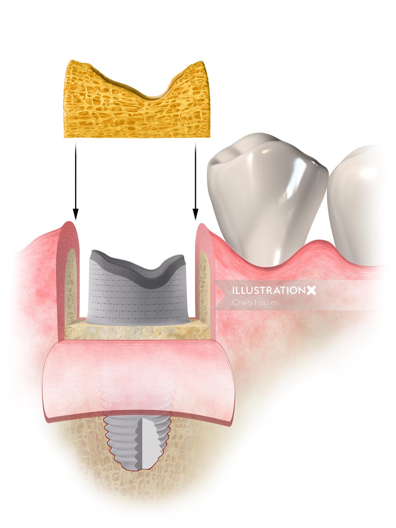 Ilustração médica de procedimento odontológico