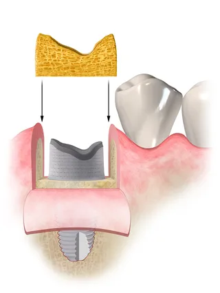 Ilustração médica de procedimento odontológico
