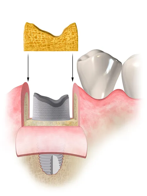 Medical illustration of dental procedure
