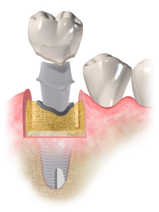 Ilustração médica do procedimento de implante
