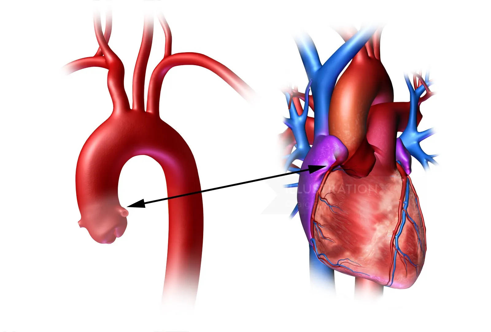 Illustration of human heart showing aortic root and coronary branches by Craig Foster