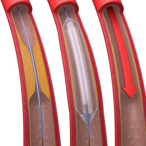Coronary artery treated with balloon angioplasty and stent by Craig Foster