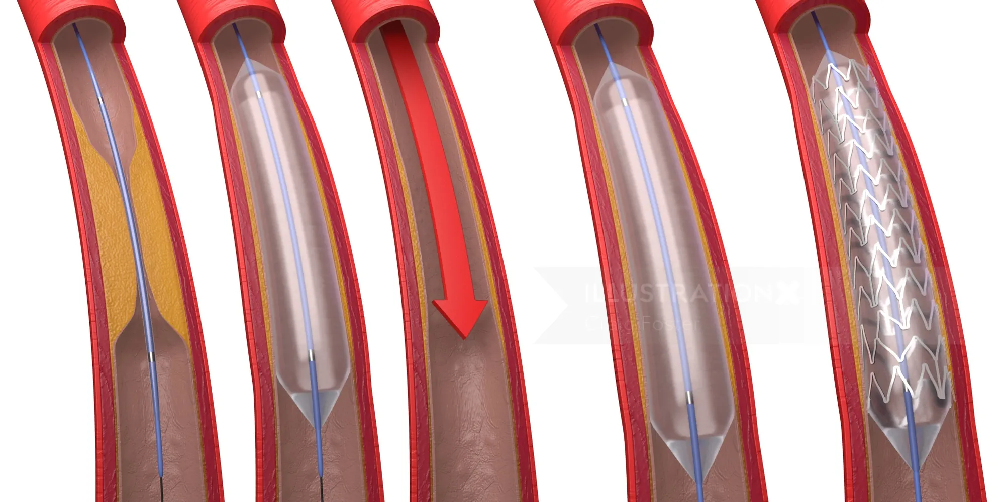 Coronary artery treated with balloon angioplasty and stent by Craig Foster