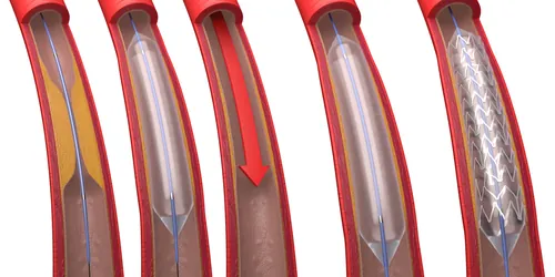 Coronary artery treated with balloon angioplasty and stent by Craig Foster