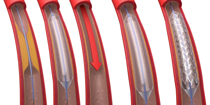 Coronary artery treated with balloon angioplasty and stent by Craig Foster