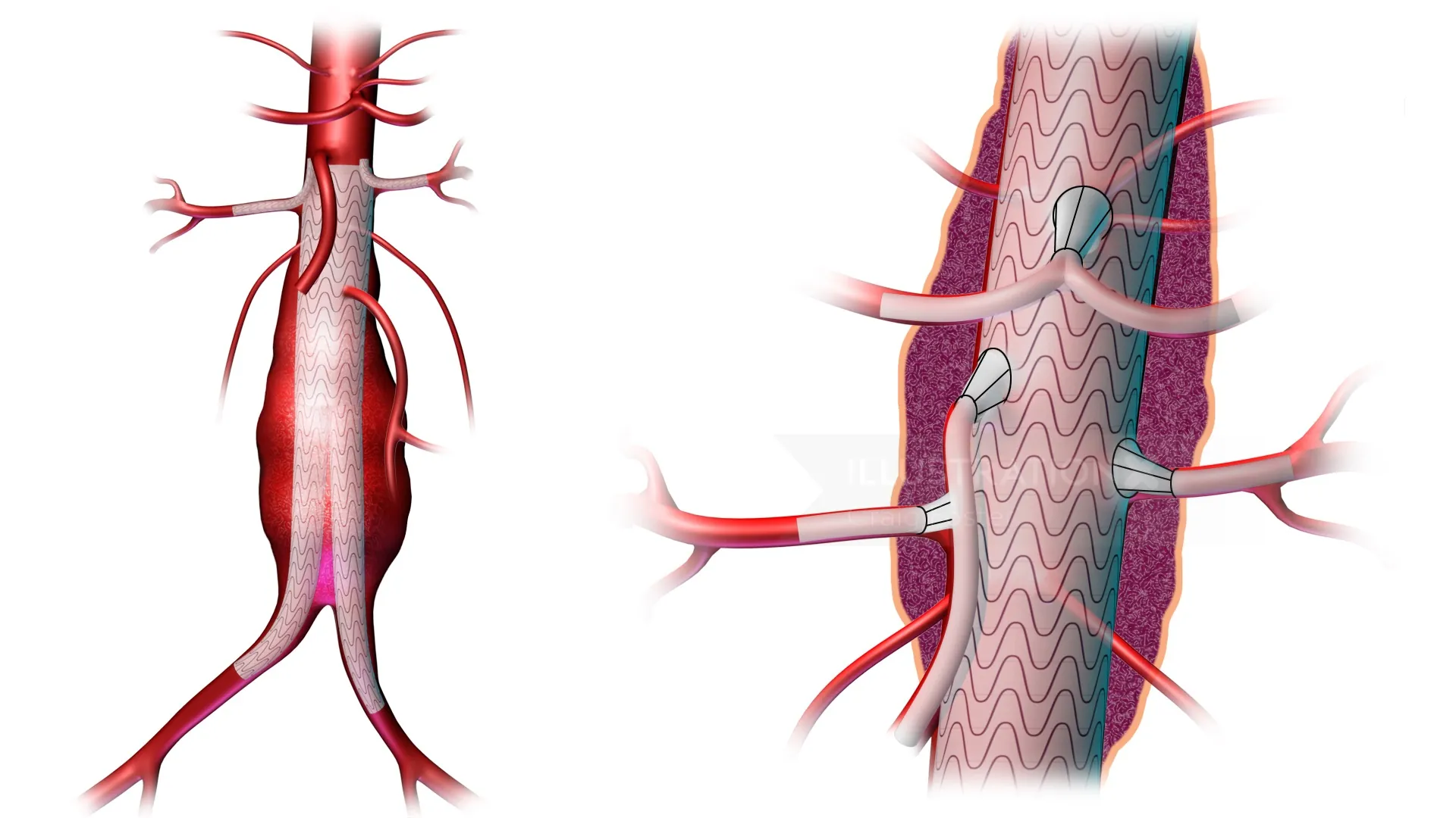 Detailed abdominal aortic graft showing blood vessels by Craig Foster