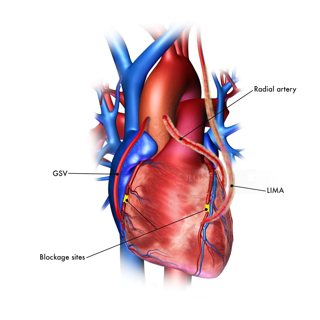 Medical illustration of coronary bypass with labeled arteries by Craig Foster