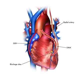 Medical illustration of coronary bypass with labeled arteries by Craig Foster