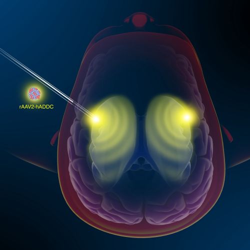 Illustration of AADC gene therapy targeting brain regions by Craig Foster