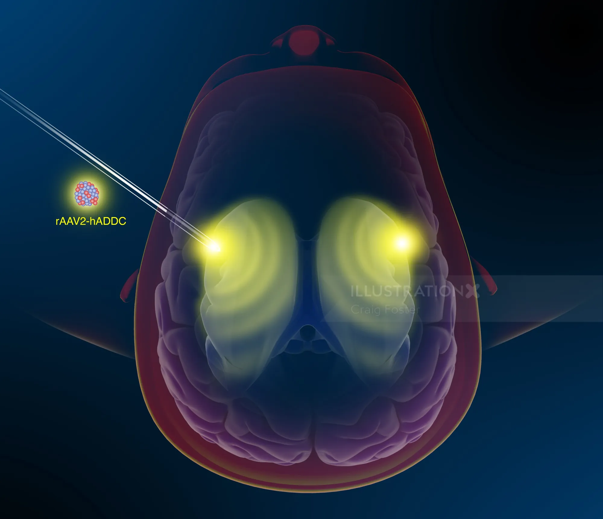 Illustration of AADC gene therapy targeting brain regions by Craig Foster