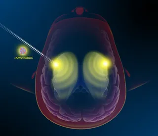 Illustration of AADC gene therapy targeting brain regions by Craig Foster