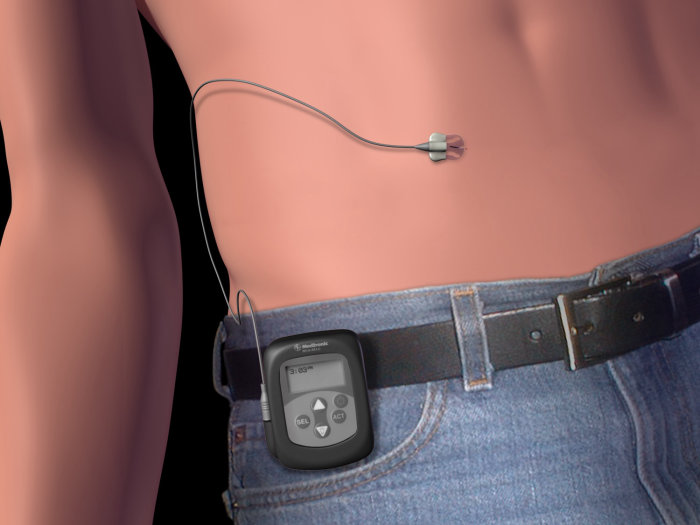 An illustration of insulin monitoring device