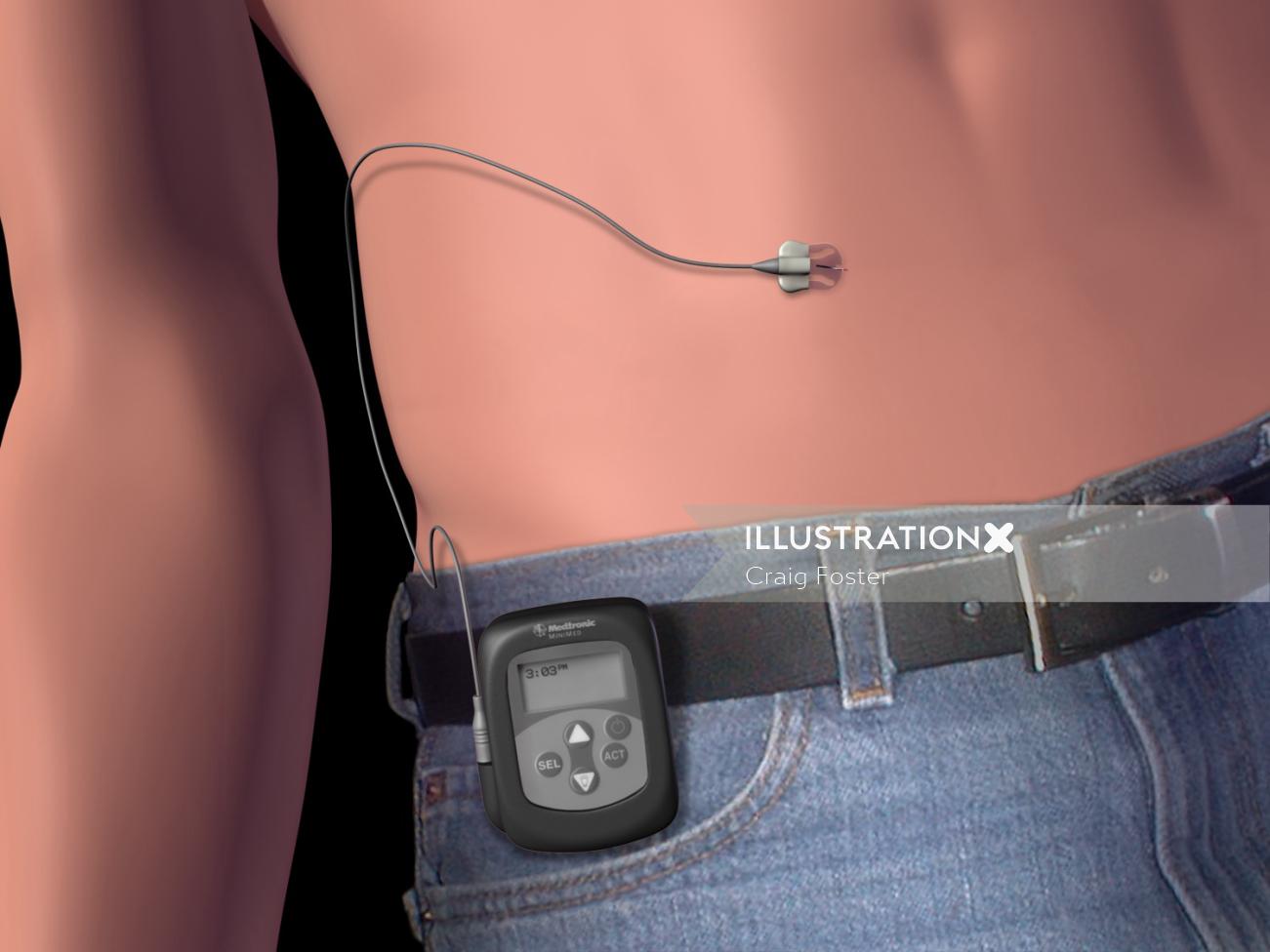 Uma ilustração do dispositivo de monitoramento de insulina