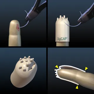 Uma ilustração de cirurgia de punção com agulha