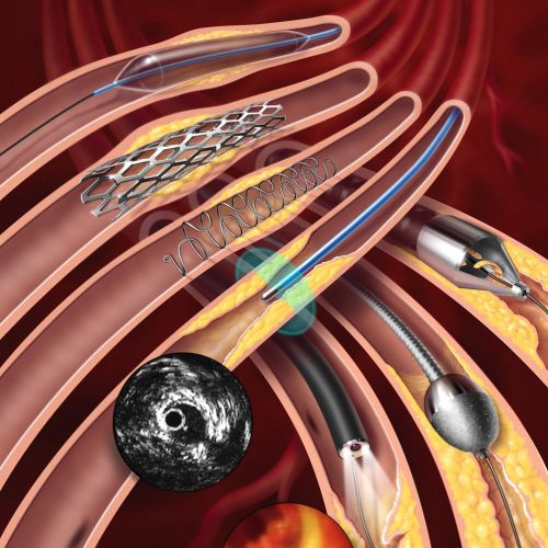 Endovascular stents and catheters inside blood vessels by Craig Foster