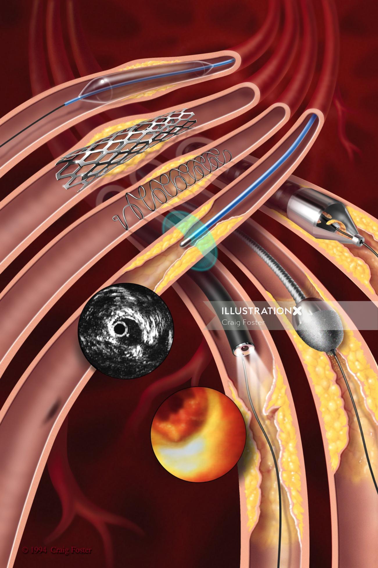 Uma ilustração da ilustração endovascular
