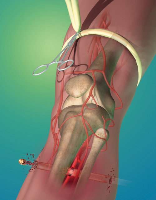 An illustration of tournaquet to prevent blood loss