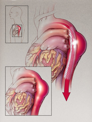 Una ilustración de un injerto de aneurisma torácico