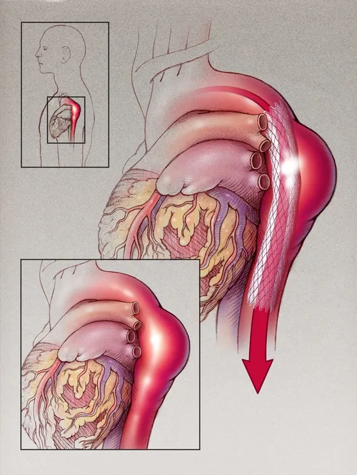 An illustration of thoracic aneurysm graft