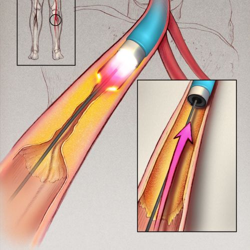 An illustration of atherosclerosis in the Leg