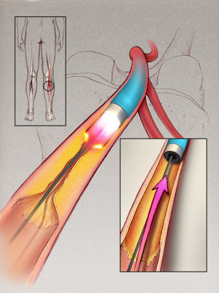Una ilustración de la aterosclerosis en la pierna.