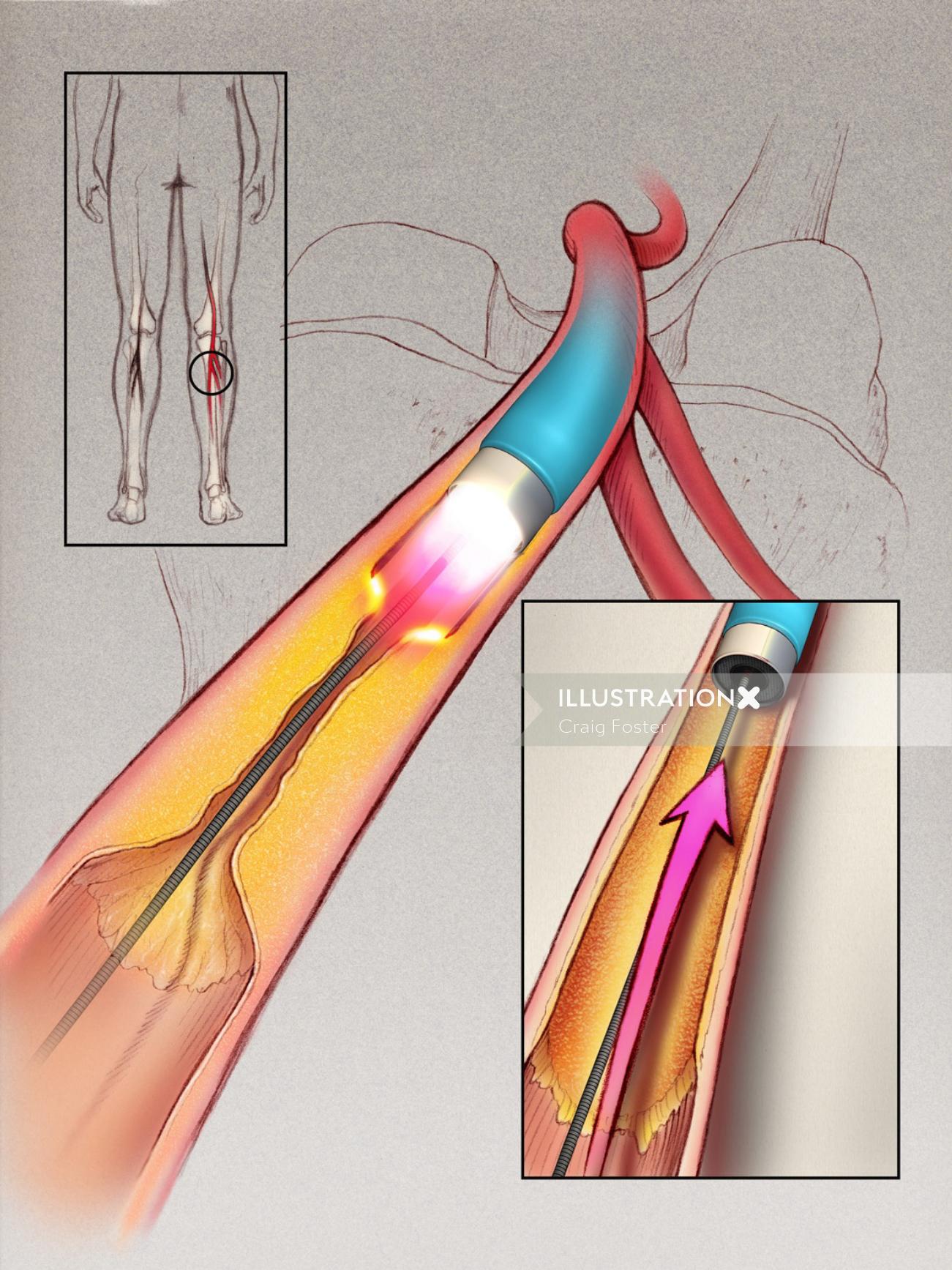 Uma ilustração da aterosclerose na perna