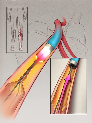 Uma ilustração da aterosclerose na perna