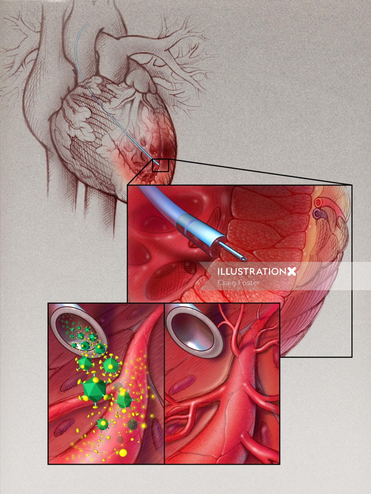 Terapia VEGF para ilustração cardíaca