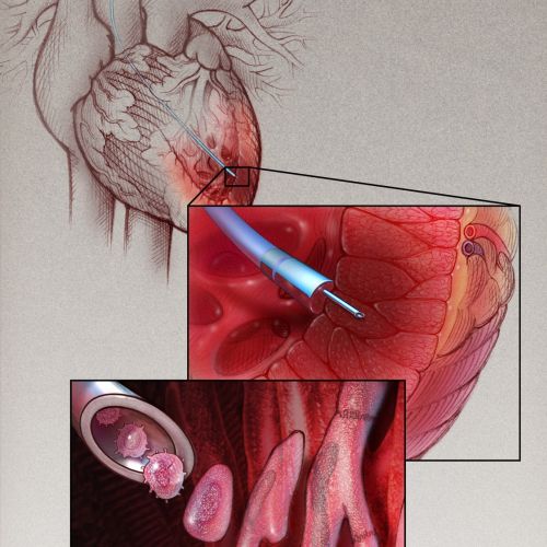 Myoblast Therapy for Cardiac illustration